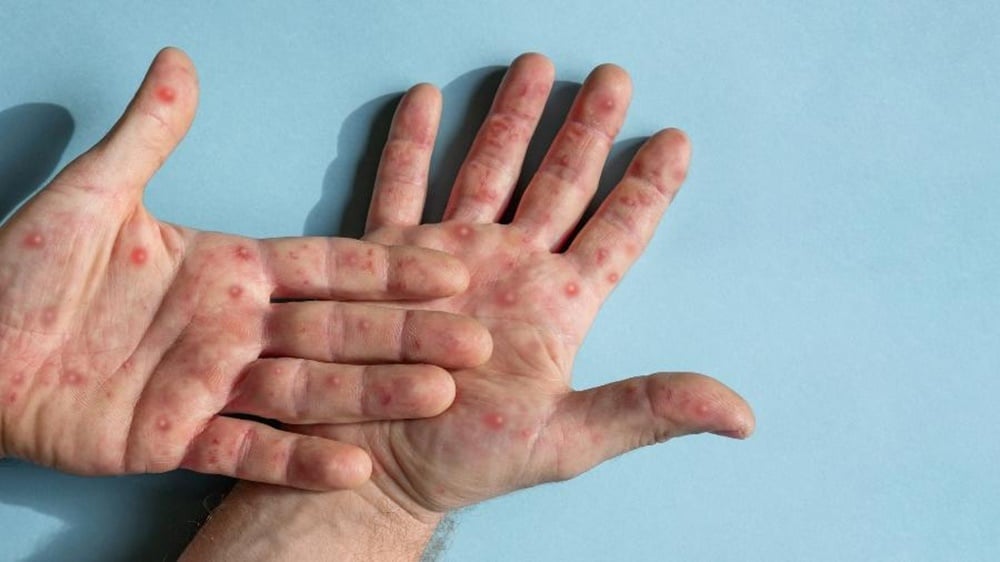 Sesapi confirma 10 casos da varíola dos macacos no Piauí; 55 são suspeitos - Foto: Reprodução